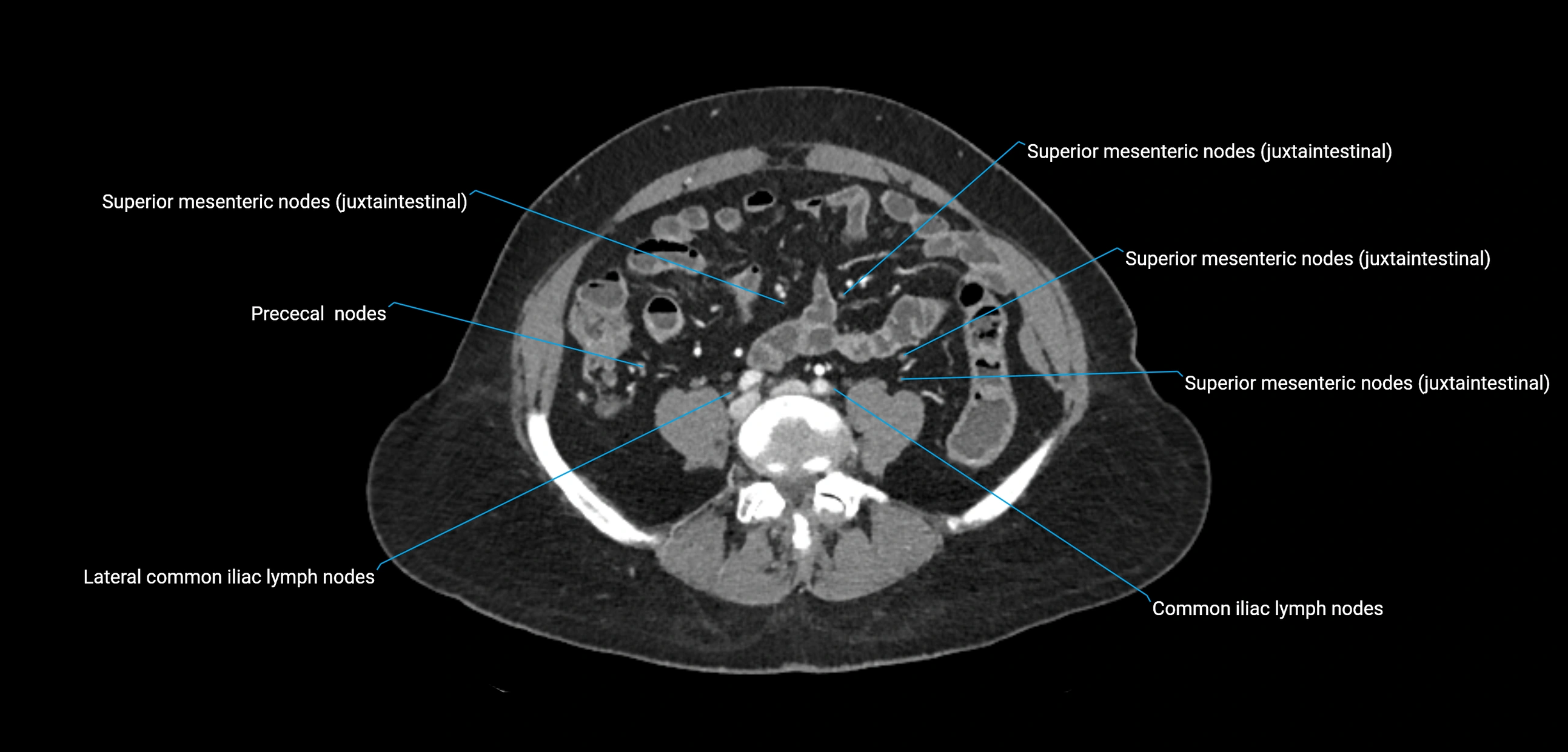 CT ct abdominal lymph nodes  axial cross sectional anatomy  enchanced radiology image -img-00002-00285.webp